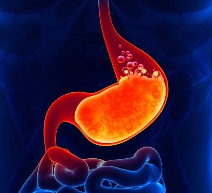 Acid Reflux Treatment Dubai